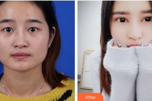 亳州雷賽眼科醫(yī)院周湘紅整形價(jià)格表附眼部手術(shù)案例展示