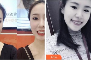 亳州康美口腔醫(yī)院李洋洋整形價(jià)格表附牙齒隱形矯正案例展示