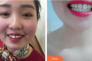 亳州康美口腔醫(yī)院趙威整形價(jià)格表附牙齒矯正案例展示