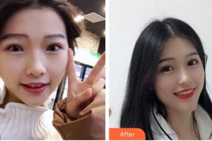 亳州郭琳口腔診所馮苗苗整形價(jià)格表附牙齒矯正案例展示