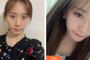 廣州壹加壹美容醫(yī)院項(xiàng)美連整形價(jià)格表附顴骨顴弓案例展示