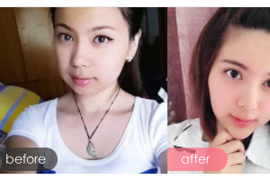 廣州愛來(lái)（原阿瑪施）醫(yī)療美容整形醫(yī)院王志農(nóng)整形價(jià)格表附下頜角整形案例展示