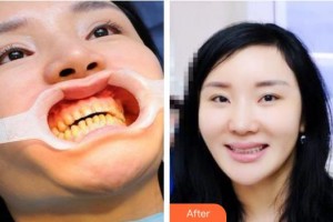 池州伊尚美醫(yī)療美容門(mén)診部許黎龍整形價(jià)格表附牙齒矯正案例展示