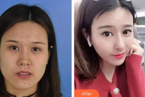 池州伊尚美醫(yī)療美容門診部江啟富整形價格表附鼻部綜合案例展示