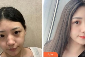 池州佳美皮膚美容醫(yī)院章巧云整形價格表附激光祛斑案例展示