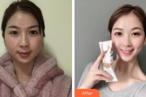 池州佳美皮膚美容醫(yī)院吳成安整形價格表附激光祛斑案例展示