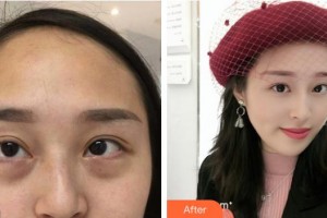 池州愛爾眼科醫(yī)院陳祥雷整形價格表附內(nèi)切祛眼袋案例展示