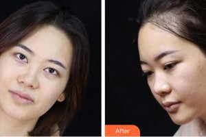 池州市人民醫(yī)院眼科姚有根整形價格表附眼鼻部手術案例展示