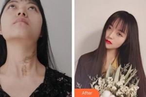 宣城人民醫(yī)院燒傷整形科劉登河整形價格表附燙傷疤痕修復案例展示