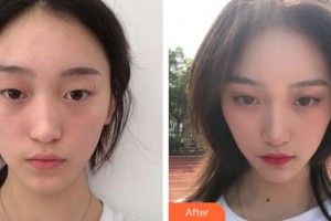 宣城眼科醫(yī)院張解忠整形價格表附眼部綜合案例展示