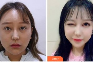 宣城眼科醫(yī)院吳志兵整形價格表附眼部綜合案例展示