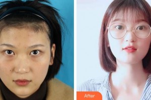 宣城眼科醫(yī)院楊國棟整形價格表附內(nèi)切祛眼袋案例展示