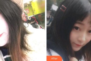 宣城為民口腔門診部李學峰整形價格表附金屬托槽矯正案例展示