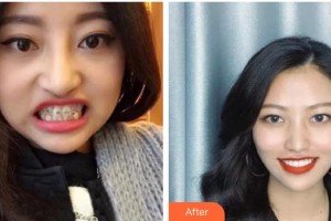 宣城為民口腔門診部王娟娟整形價格表附牙齒陶瓷矯正案例展示