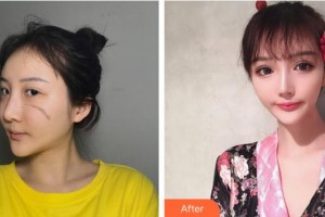 浙江大學(xué)醫(yī)學(xué)院附屬第二醫(yī)院整形科邵哲人整形價(jià)格表附激光祛疤案例展示