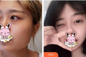 浙江省人民醫(yī)院整形外科朱保整形價(jià)格表附面部整形案例展示