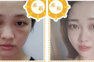 浙江綠城醫(yī)院整形美容中心張曉清整形價(jià)格表附埋線提升案例展示