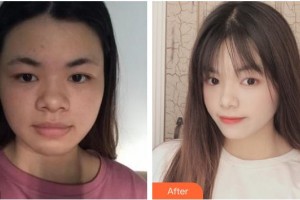 浙江綠城醫(yī)院整形美容中心趙峻賢整形價(jià)格表附埋線提升案例展示