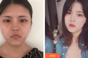 浙江衢化醫(yī)院激光整形美容中心康樂整形價(jià)格表附埋線提升案例展示