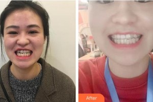 浙江大學(xué)醫(yī)學(xué)院附屬口腔醫(yī)院胡濟(jì)安整形價(jià)格表附牙齒隱形矯正案例展示