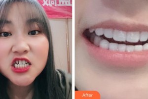 浙江大學(xué)醫(yī)學(xué)院附屬口腔醫(yī)院施潔珺整形價(jià)格表附牙貼面案例展示