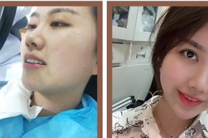 浙江大學(xué)醫(yī)學(xué)院附屬口腔醫(yī)院何虹整形價(jià)格表附美白貼片案例展示