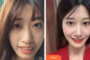 浙江大學(xué)醫(yī)學(xué)院附屬口腔醫(yī)院關(guān)曉旭整形價(jià)格表附牙齒陶瓷矯正案例展示