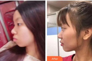 浙江大學(xué)醫(yī)學(xué)院附屬口腔醫(yī)院周藝群整形價(jià)格表附金屬托槽矯正案例展示