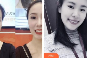 浙江大學(xué)醫(yī)學(xué)院附屬口腔醫(yī)院程俊杰整形價(jià)格表附牙齒隱形矯正案例展示