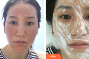 廣州海峽醫(yī)學(xué)整形美容醫(yī)院周紅英整形價格表附點陣激光祛痘印案例展示