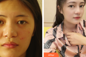 廣州軍區(qū)武漢總醫(yī)院醫(yī)學(xué)整形美容中心徐凱整形價格表附自體肋骨隆鼻案例展示