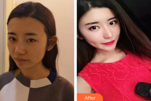 廣州星念醫(yī)療美容門診部陳春梅整形價格表附黑臉娃娃案例展示