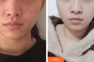 廣州美瑞兒醫(yī)療美容門診部郭昱整形價格表附祛斑祛痣案例展示