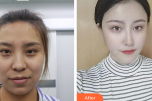 廣州壹加壹美容醫(yī)院李明整形價格表附面部吸脂案例展示