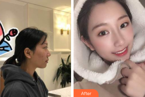 廣州凱美達整形美容醫(yī)院陽海斌整形價格表附耳軟骨鼻部手術(shù)案例展示