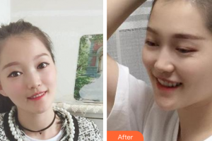 廣州圣貝口腔門診部武玉海整形價格表附金屬托槽矯正案例展示