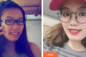 廣州圣貝口腔門診部楊妙芬整形價格表附牙齒矯正案例展示