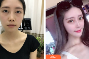 廣州弘基醫(yī)療美容門診部金敏碩整形價格表附膨體墊下巴案例展示