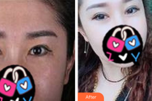 廣州圣諾達醫(yī)療美容門診部周豐整形價格表附重臉術(shù)修復(fù)案例展示