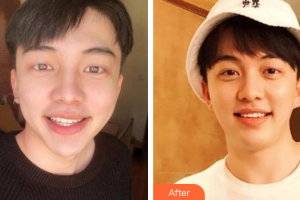 廣州圣貝口腔門診部胡曉文整形價格表附瓷貼面案例展示