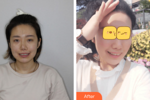 廣州穗華口腔醫(yī)院張春雷整形價格表附牙齒隱形矯正案例展示