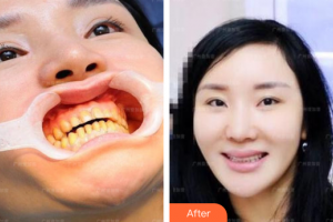 廣州穗華口腔醫(yī)院趙清桐整形價格表附瓷貼面案例展示