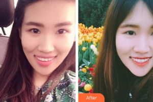 廣州穗華口腔醫(yī)院李澤鍵整形價格表附牙齒隱形矯正案例展示