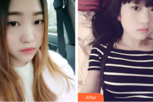 廣州穗華口腔醫(yī)院姜力整形價格表附牙齒金屬矯正案例展示