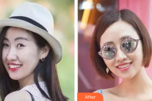 廣州穗華口腔醫(yī)院梁倩整形價格表附隱形托槽矯正案例展示