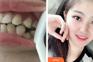 廣州穗華口腔醫(yī)院張建整形價格表附金屬托槽矯正案例展示