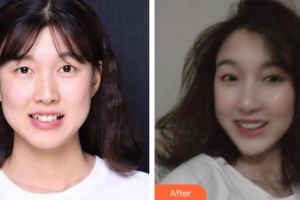 廣州穗華口腔醫(yī)院劉洋整形價格表附隱形托槽矯正案例展示