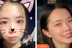 廣州穗華口腔醫(yī)院華志熙整形價格表附牙齒矯正案例展示