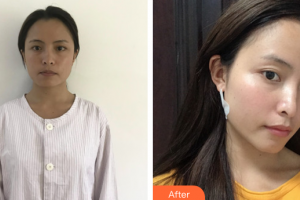 廣州深美醫(yī)療美容門診部鄧海清整形價格表附面部吸脂案例展示