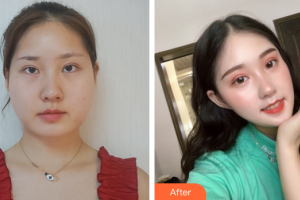 廣州姬妍醫(yī)療美容門診部何瑤整形價格表附面部吸脂案例展示